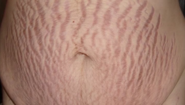 7 Ways you need to know on how to treat stretch marks ...